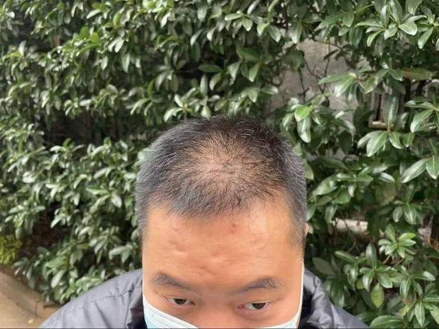 “还能反光<strong></p>
<p>债券交易市场构成</strong>！”长沙男子植发近9月称后脑勺“像狗啃过”