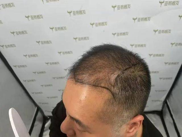 “还能反光<strong></p>
<p>债券交易市场构成</strong>！”长沙男子植发近9月称后脑勺“像狗啃过”