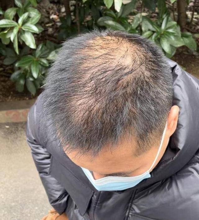 “还能反光<strong></p>
<p>债券交易市场构成</strong>！”长沙男子植发近9月称后脑勺“像狗啃过”