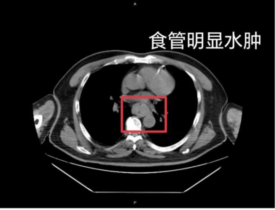 【家常话健康】一口热汤<strong></p>
<p>虚拟币挖矿整治措施</strong>，差点要了幼童的命！不是所有东西都适合“趁热吃”