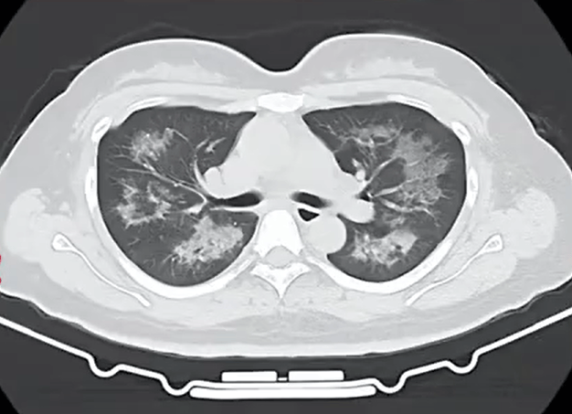 每天用2次<strong></p>
<p>貔貅盘虚拟币</strong>,22岁女主播肺里长满阴影!很多人不注意